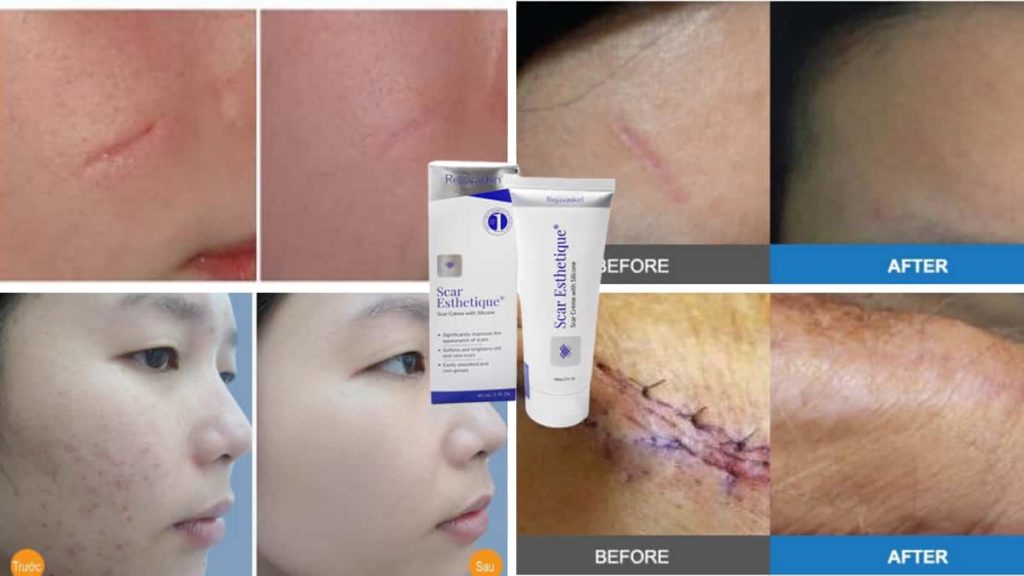 Ai nên dùng Scar Esthetique? Khi nào dùng là hiệu quả nhất, lên mua ở đâu