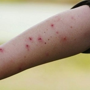 5 cách trị sẹo thâm muỗi đốt hiệu quả, hết thâm, hết ngứa
